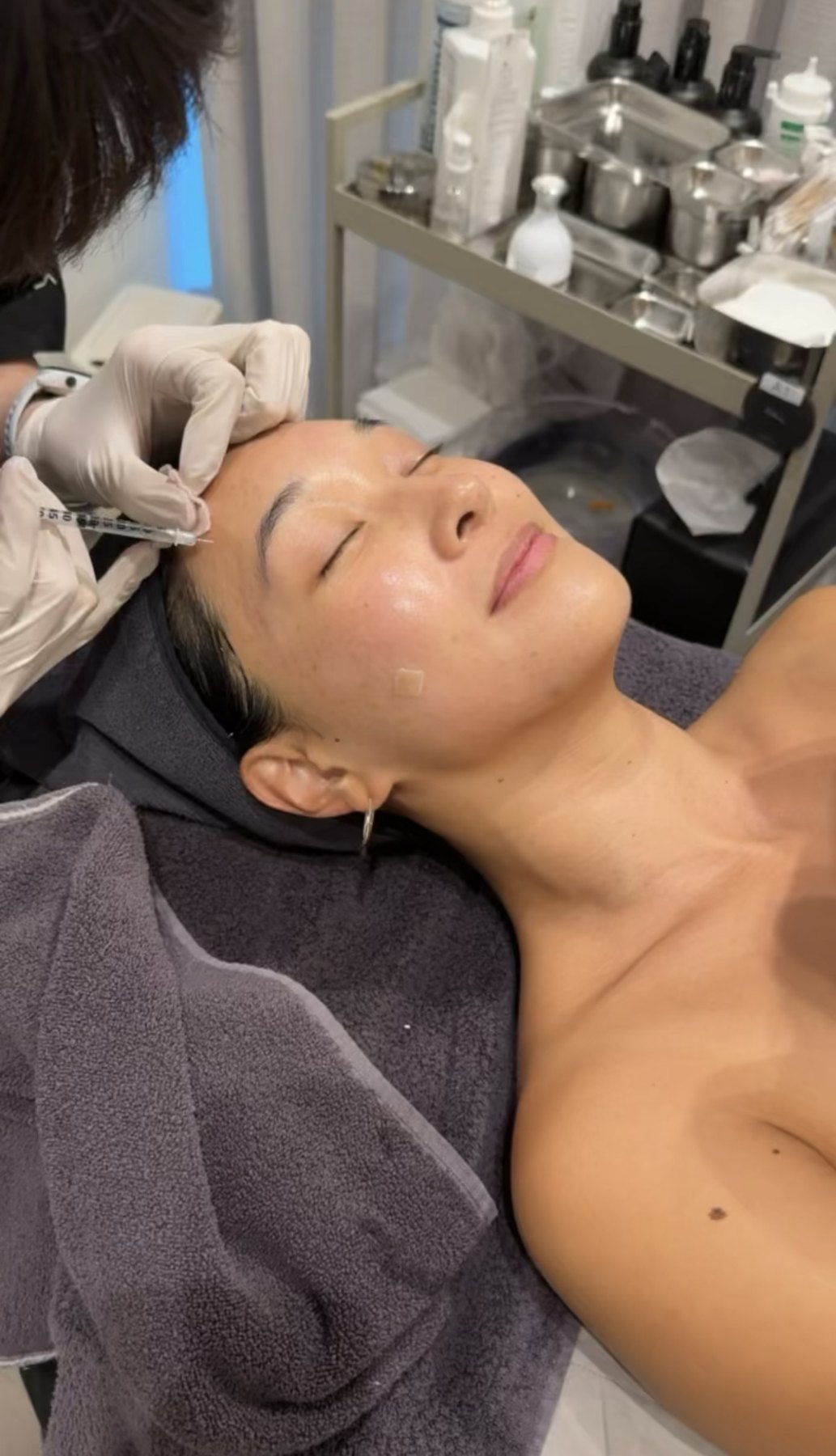 Eunice receiving forehead Xeomin